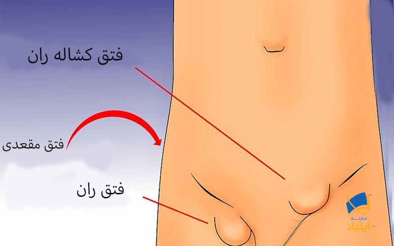 انواع فتق در ناحیه کشاله ران را بشناسید
