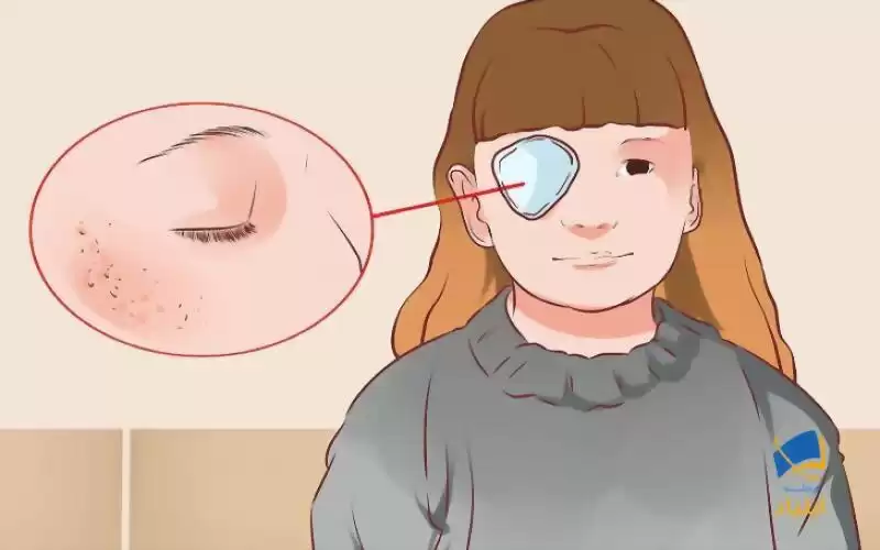 مراقبت از ناحیه چشم