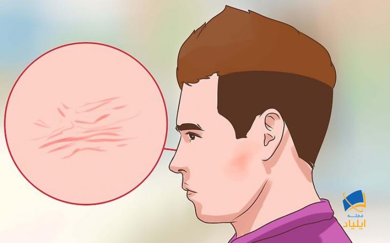 ارزیابی پوست برای علائم یرقان