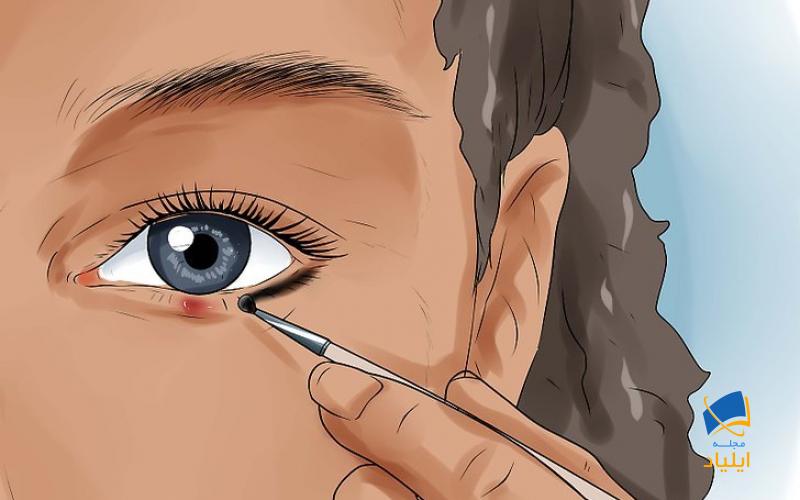 جلوگیری از عود مکرر گلمژه