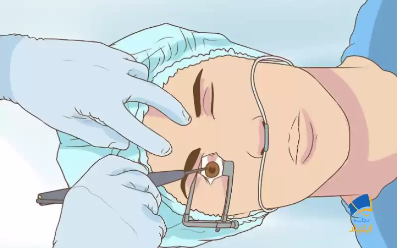 استفاده از جراحی برای درمان ناخنک چشم