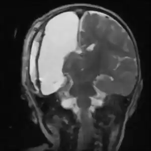 آیا عمل‌جراحی برداشتن نیمی از مغز، واقعیت دارد؟