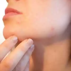 منشا آکنه‌های پوستی شما چیست؟